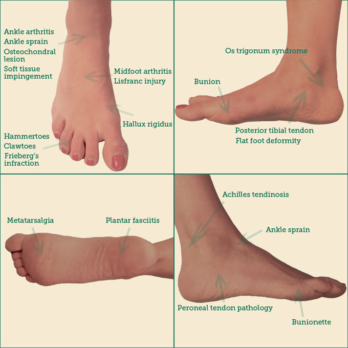 Foot & Ankle Disorders Jeffrey S. Feinblatt, MD, PC